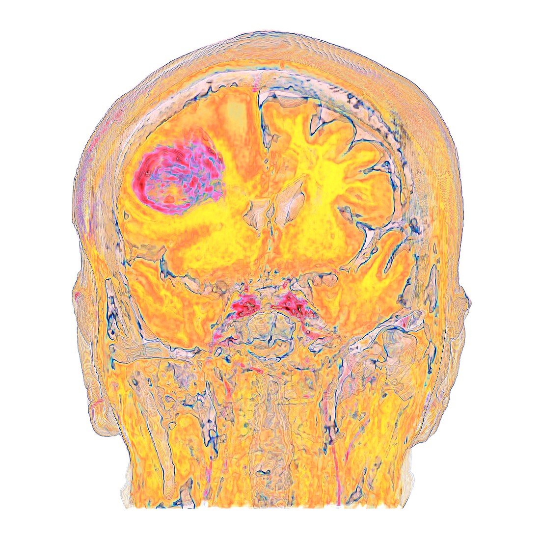 Metastatic brain cancer, MRI scan