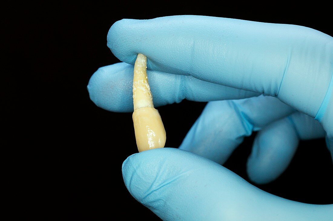 Extracted canine tooth with crown
