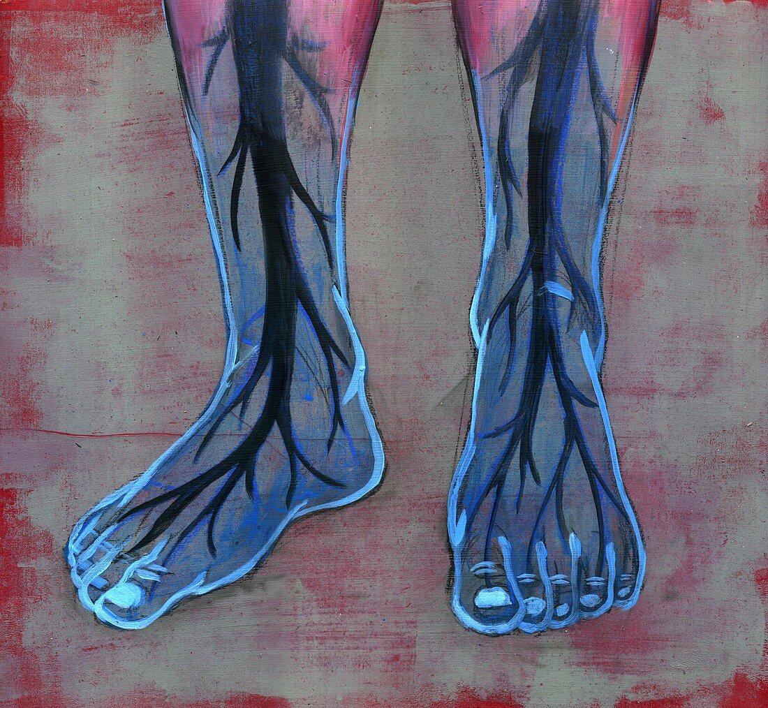 Blue feet of diabetic person, illustration