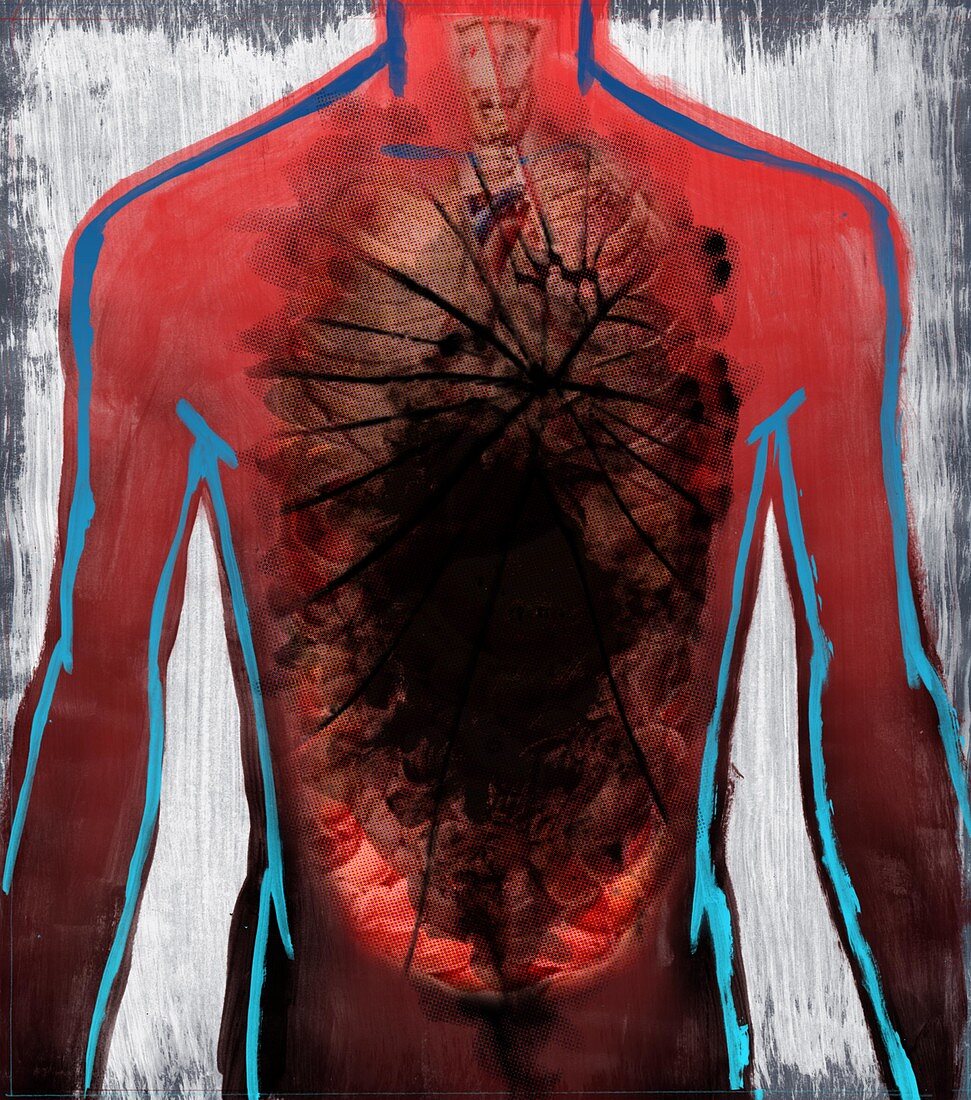 Illustration of cancer affected human organ