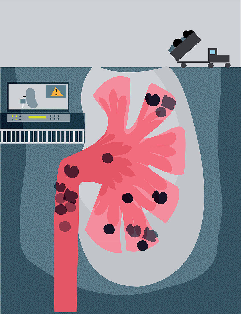 Illustration of kidney stone