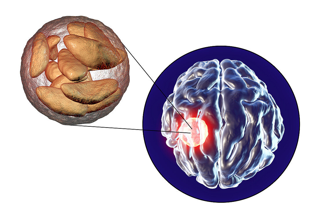 Brain abscess caused by Toxoplasma gondii, illustration