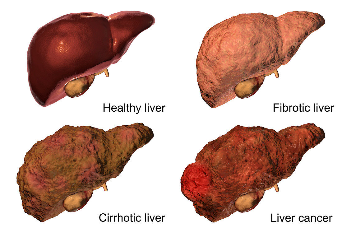 Stages of liver disease, illustration