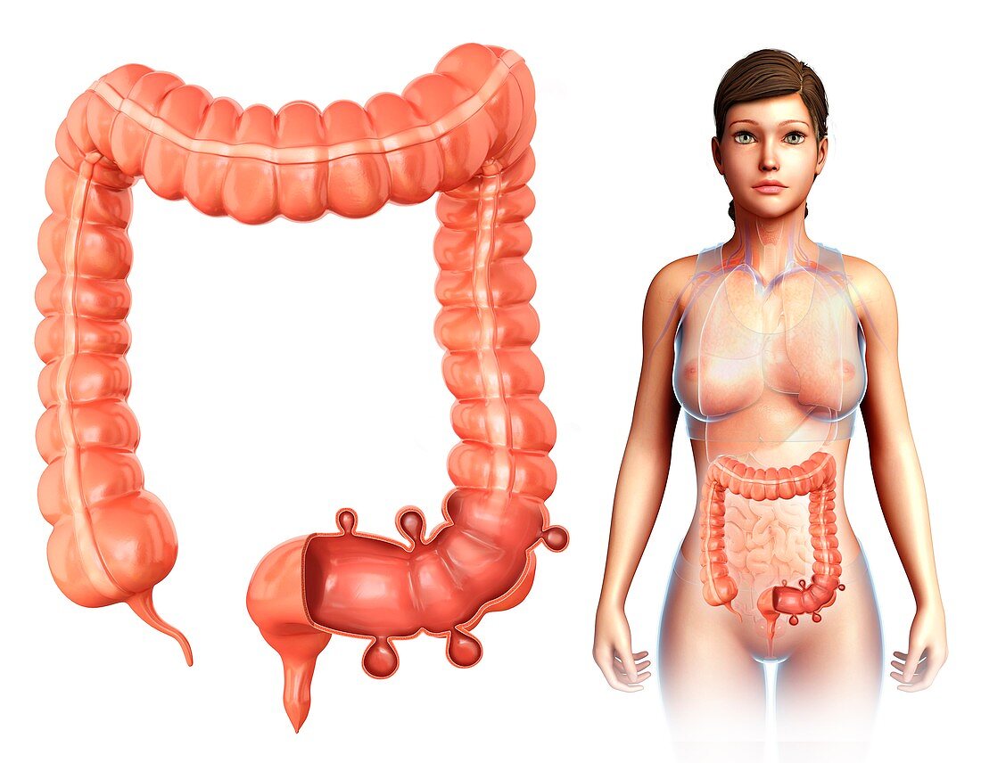 Woman with diverticulosis, illustration