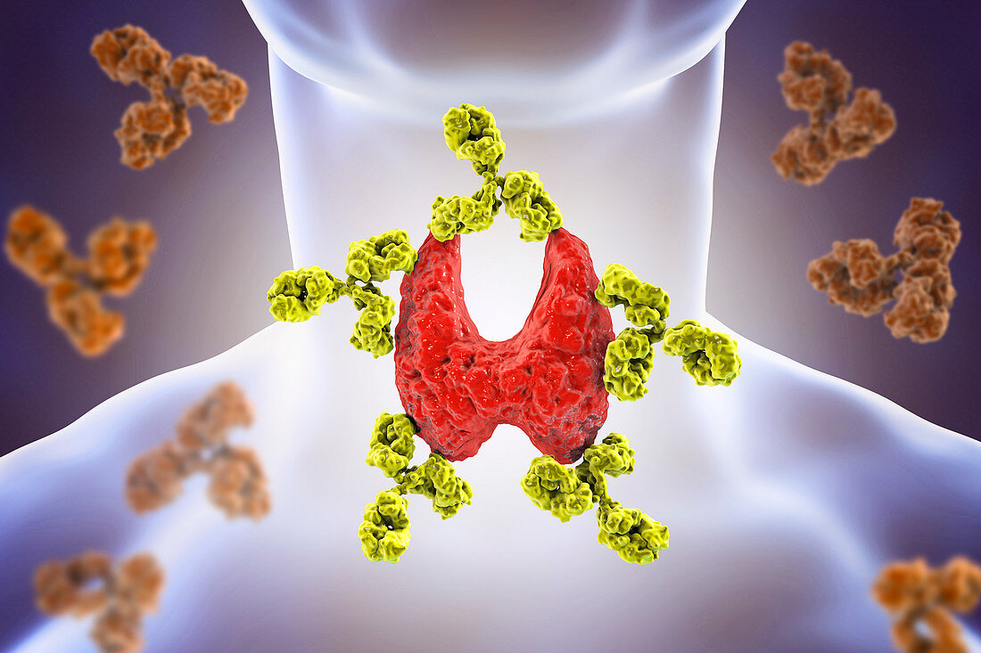Autoimmune thyroiditis, conceptual illustration