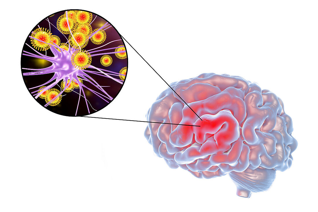 Viral encephalitis, illustration