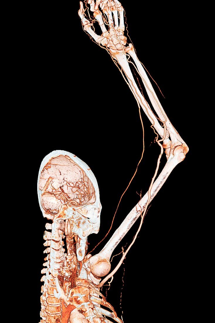 Head, shoulder and arm arteries, 3D CT angiogram