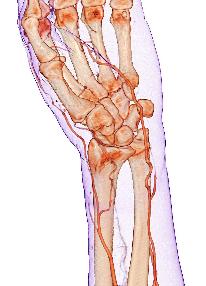 Wrist blood vessels, 3D CT angiogram