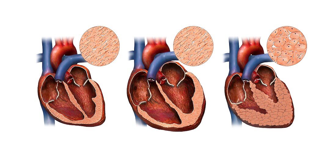 Normal and unhealthy hearts, illustration