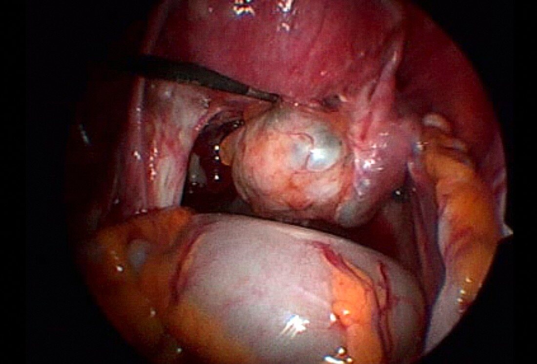 Ovarian endometrioma, endoscope view