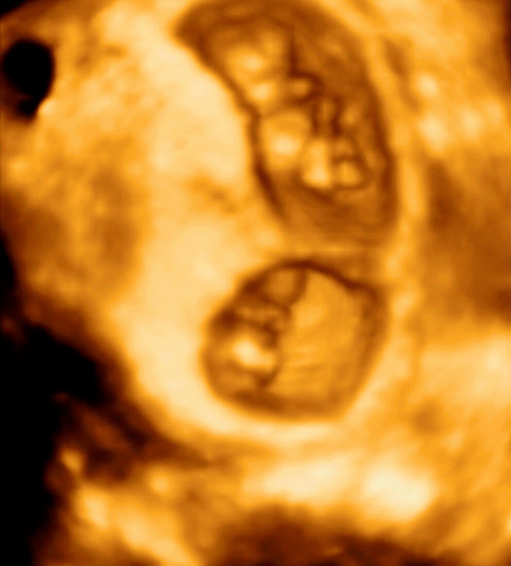 Twin foetuses, 3D ultrasound scan