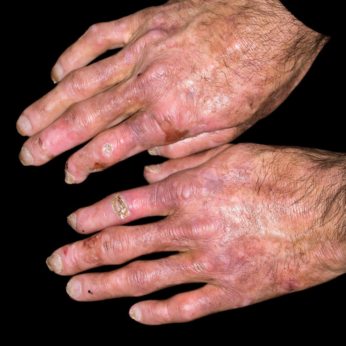Hands in porphyria