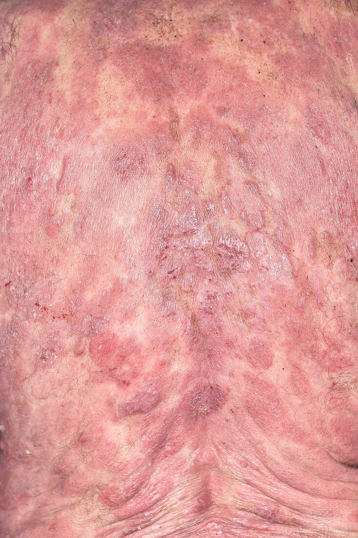Skin in mycosis fungoides cancer
