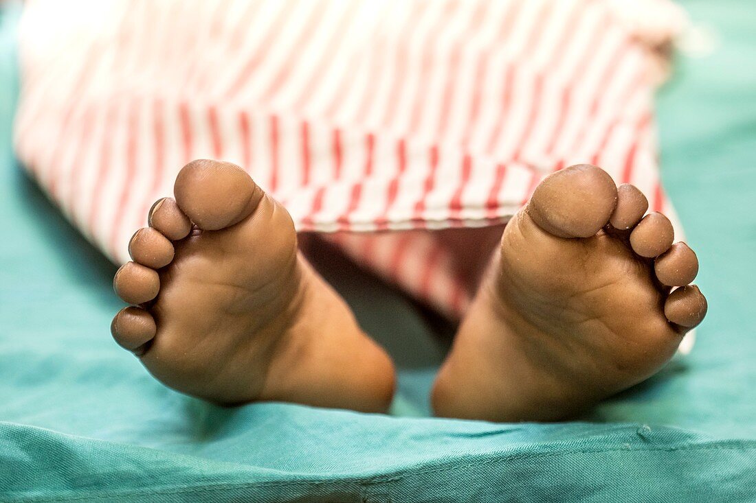 Feet of a child awaiting surgery