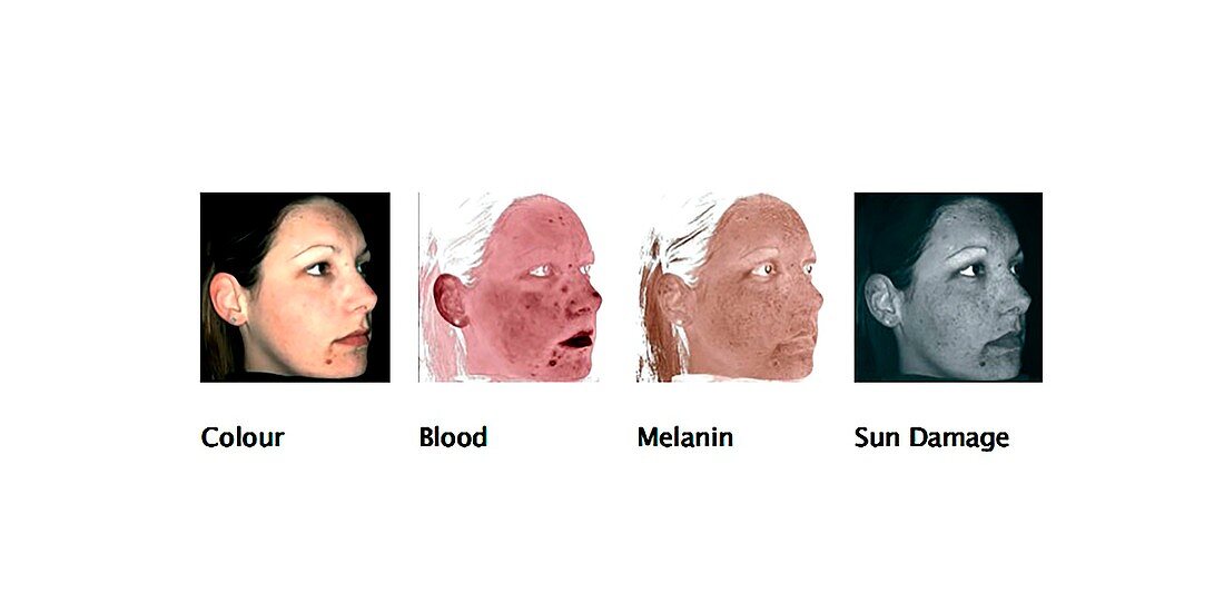 Skin health analysis system