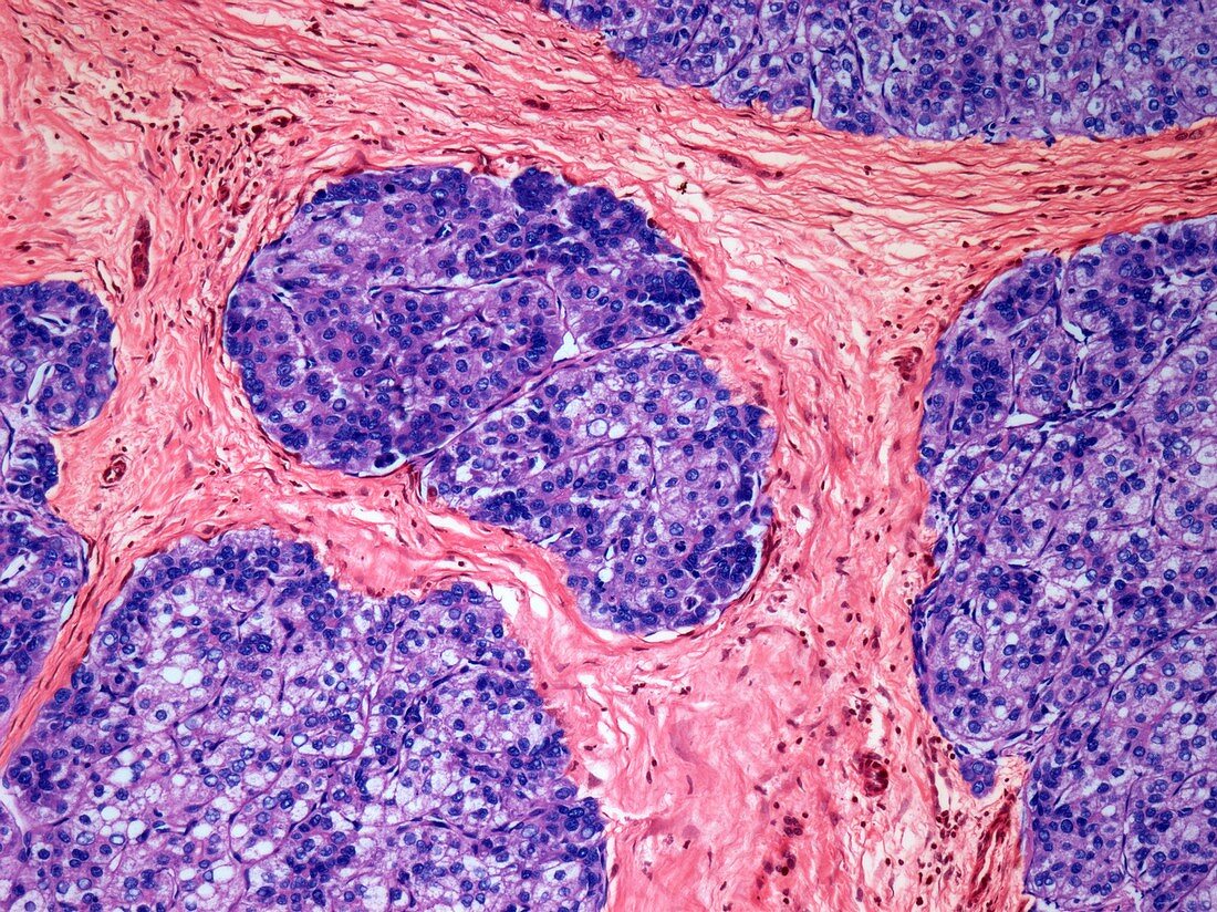 Liver cancer, light micrograph