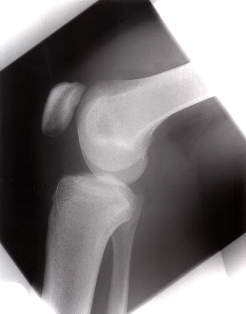 Healthy knee, X-ray