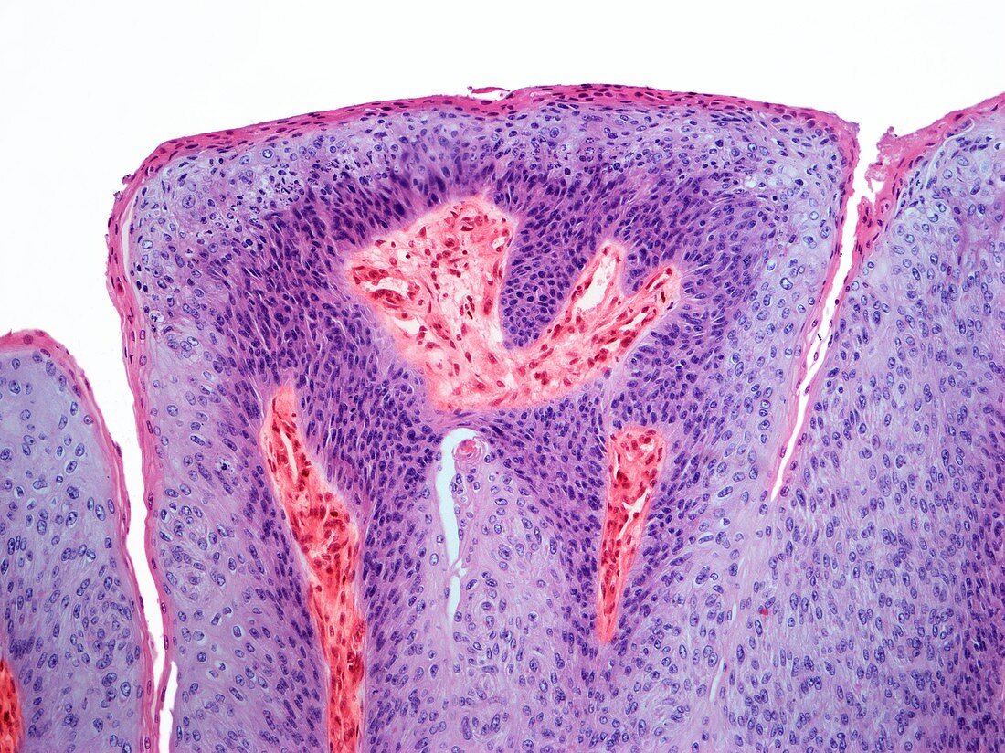 Genital wart, light micrograph