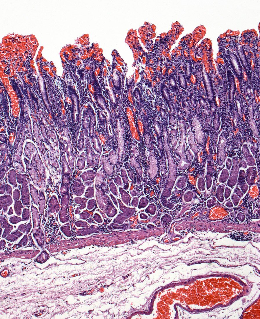 Gastritis, light micrograph