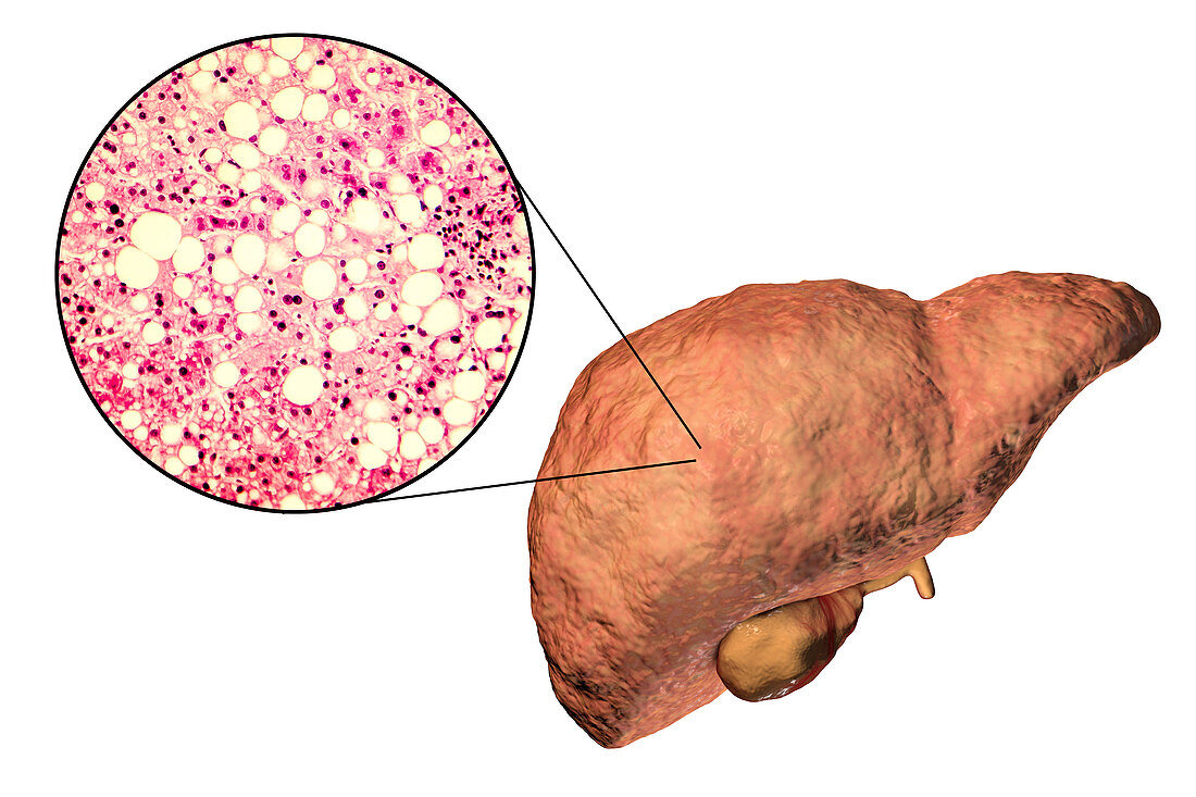 Fatty liver, illustration and micrograph