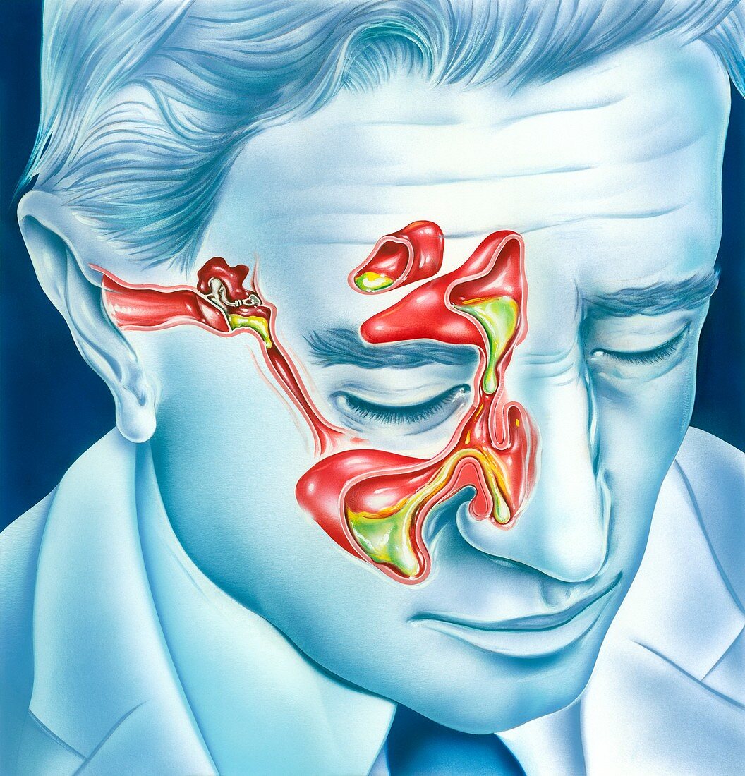 Sinus and ear infections, illustration
