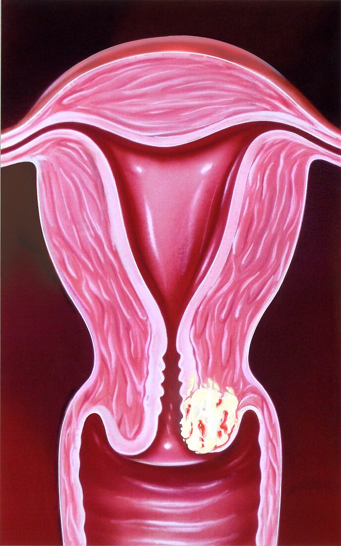 Cancer of the cervix, illustration