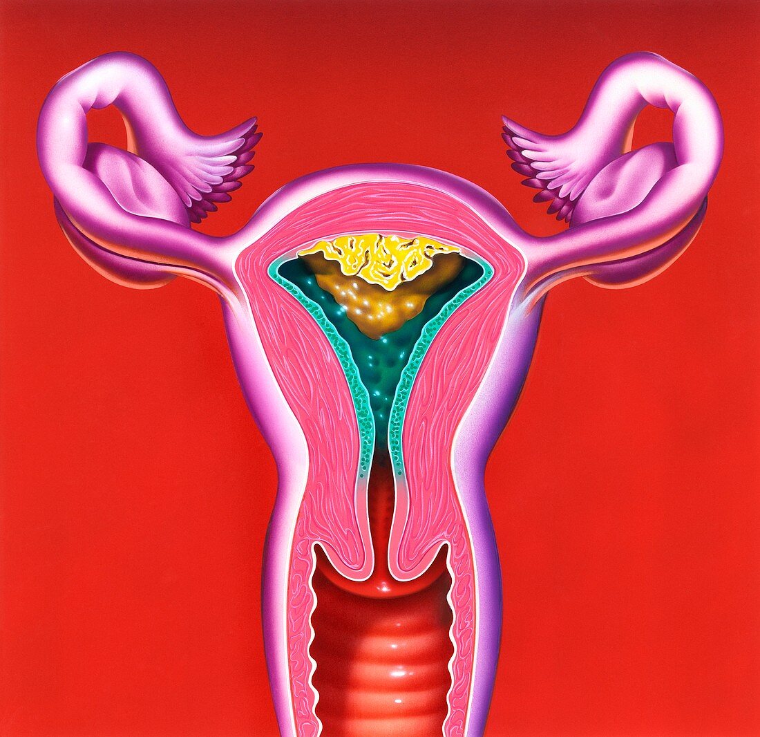 Cancer of the endometrium of the uterus, illustration