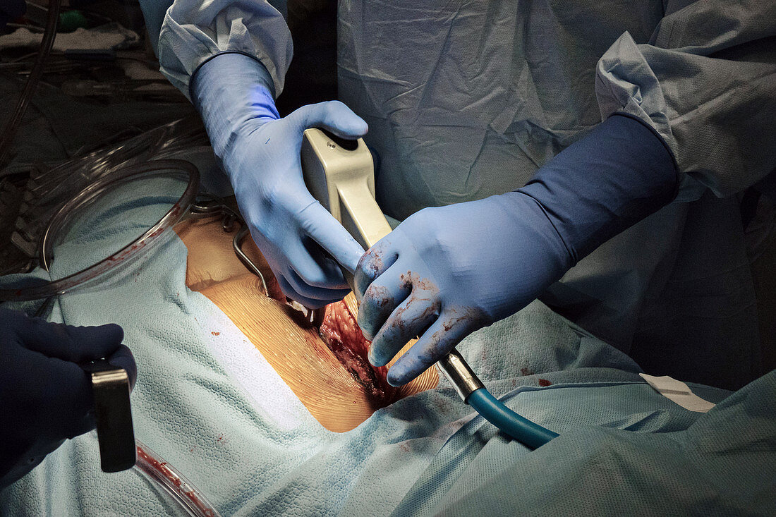 Open heart surgery, bone saw