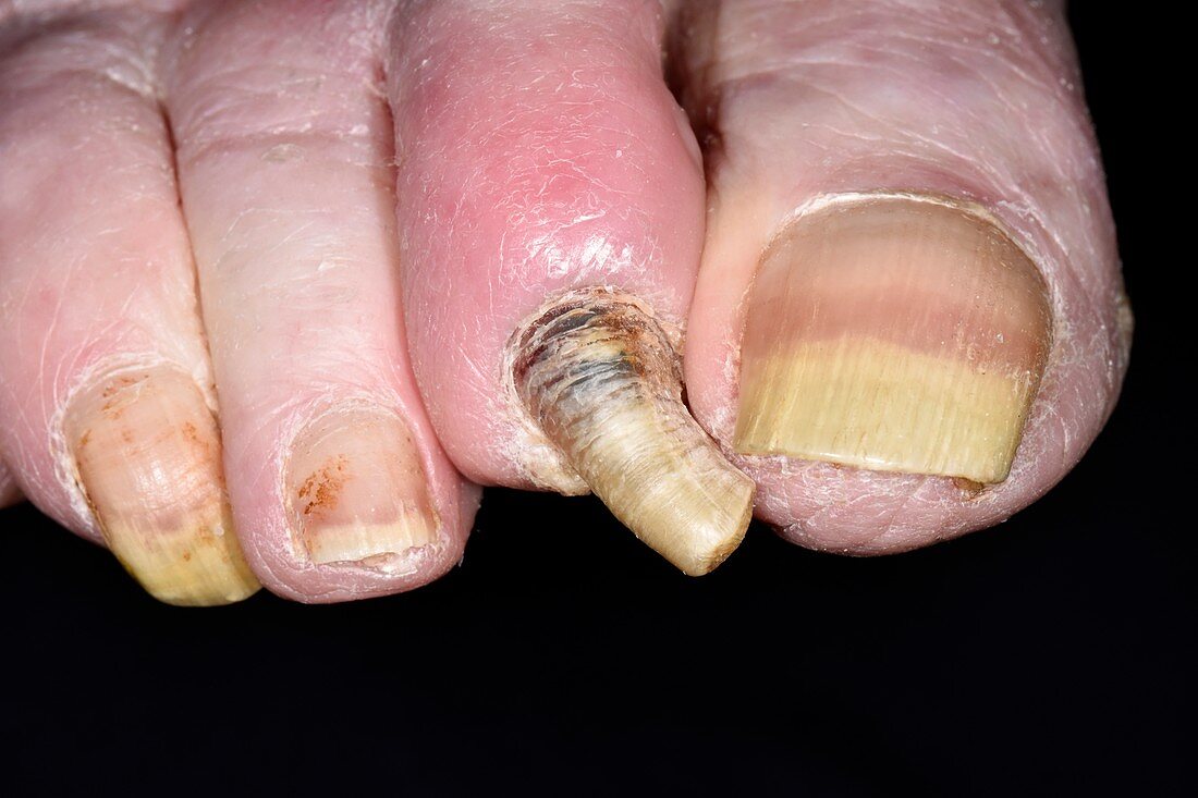 Fungal infection of the toenails