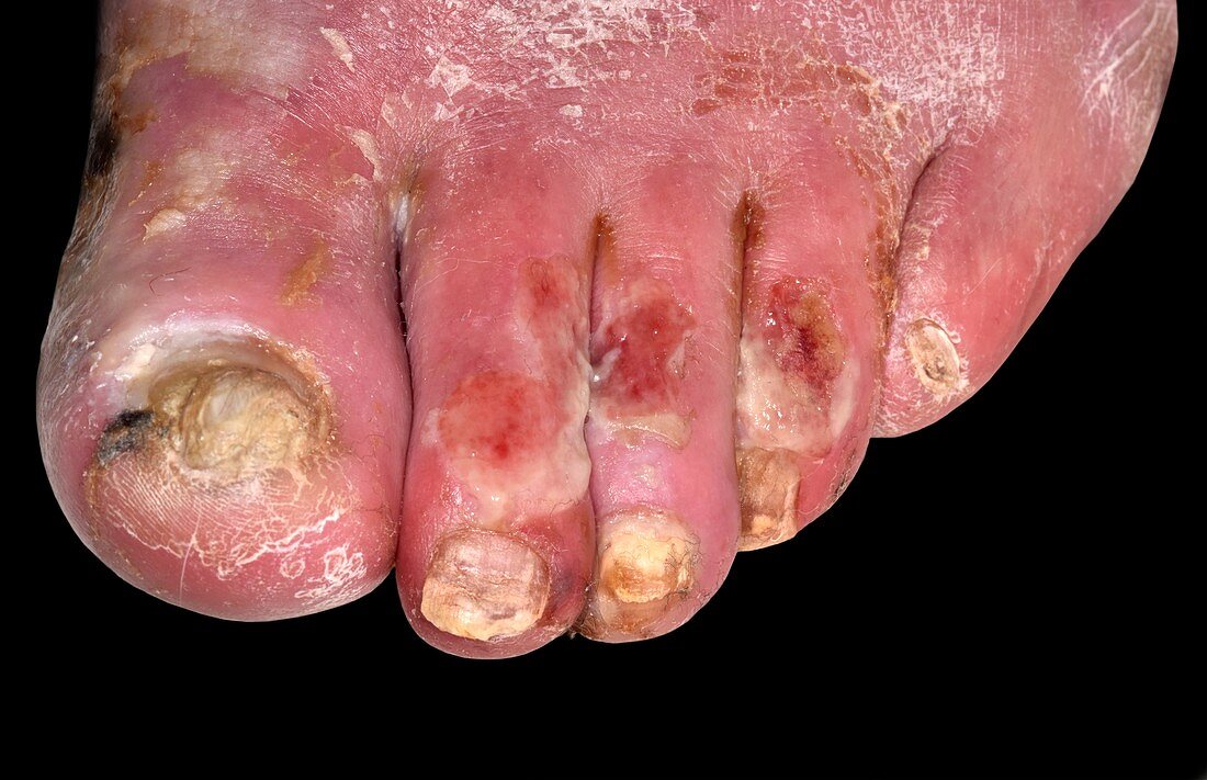 Necrotic toes in diabetes