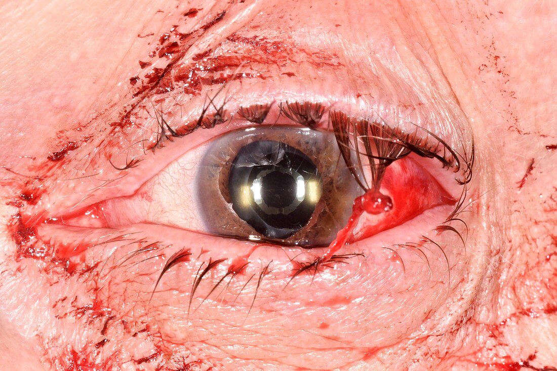 Tennis ball eye injury