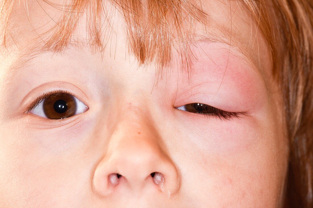 Orbital cellulitis