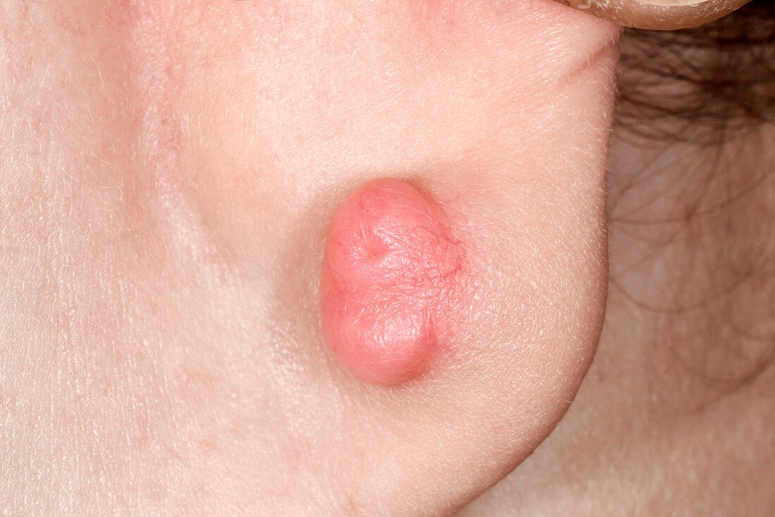 Keloid scarring after ear piercing