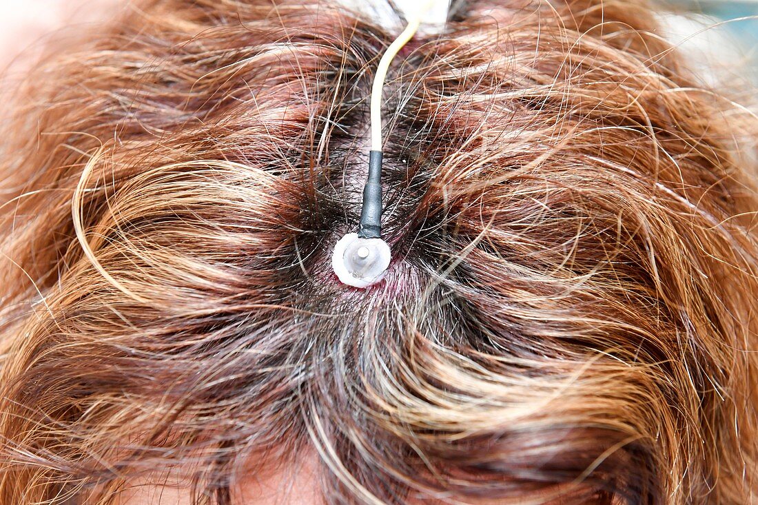 Electroencephalography electrode attached to scalp