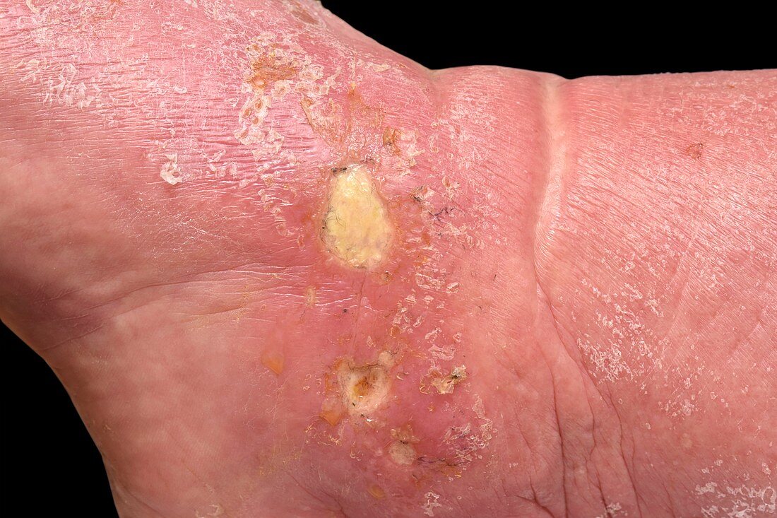 Cellulitis in alcoholic liver disease