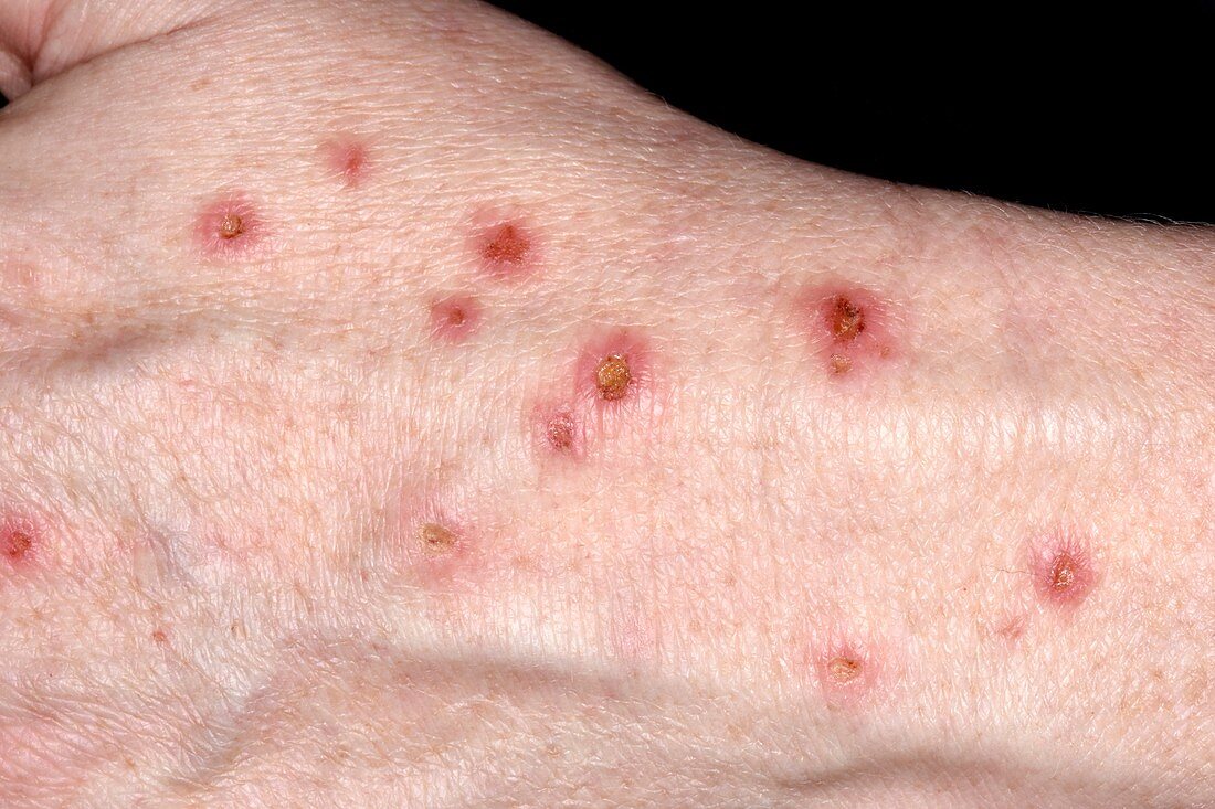 Infected nodular prurigo