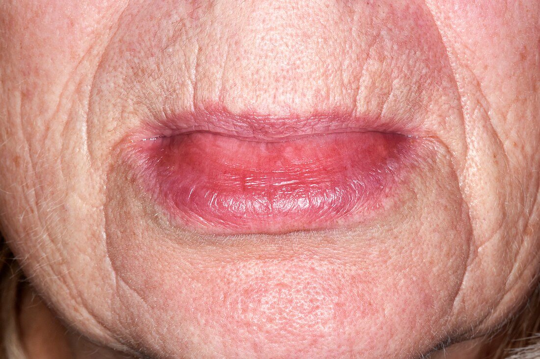 Angioedema of the lower lip