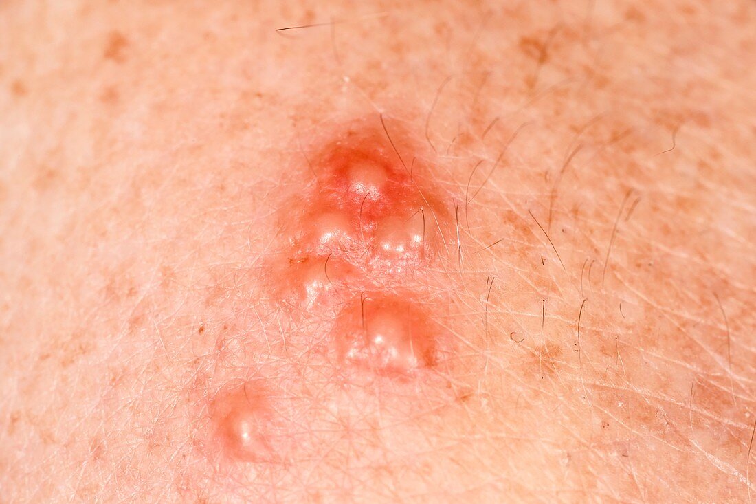 Herpes type 2 lesions