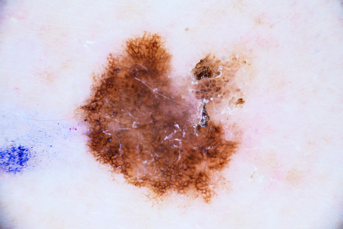 Mole diagnosis, dermascope image