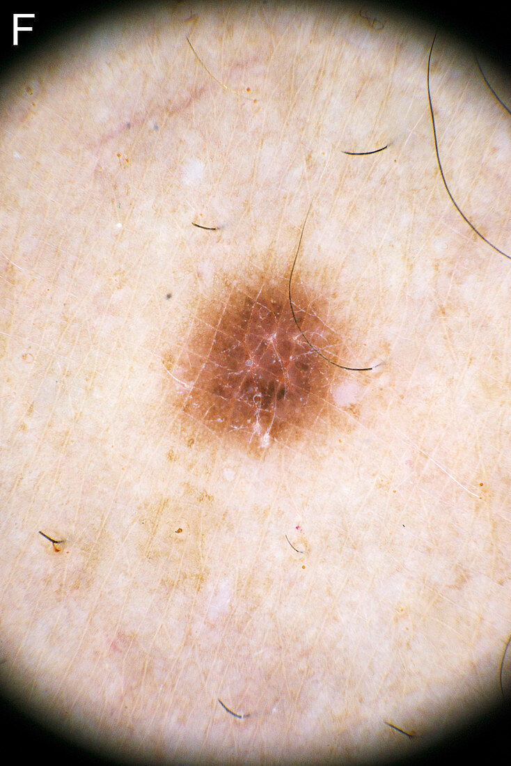 Dermatofibroma diagnosis, dermascope image