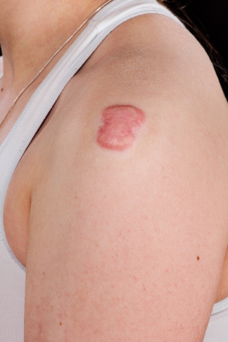Keloid scarring after chickenpox