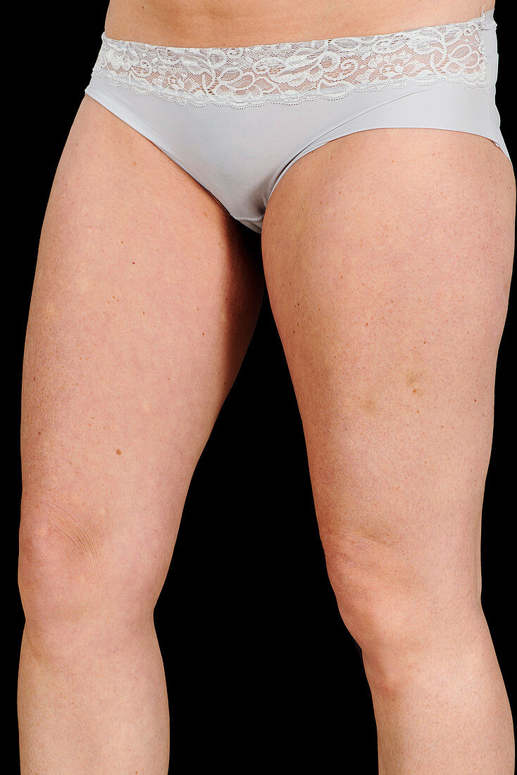 Thigh scar in breast reconstruction surgery