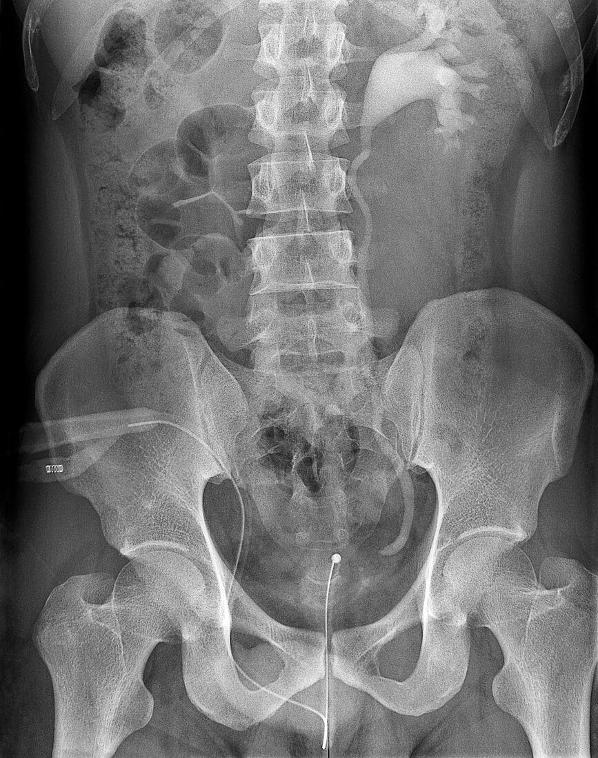 Obstructed ureter, X-ray