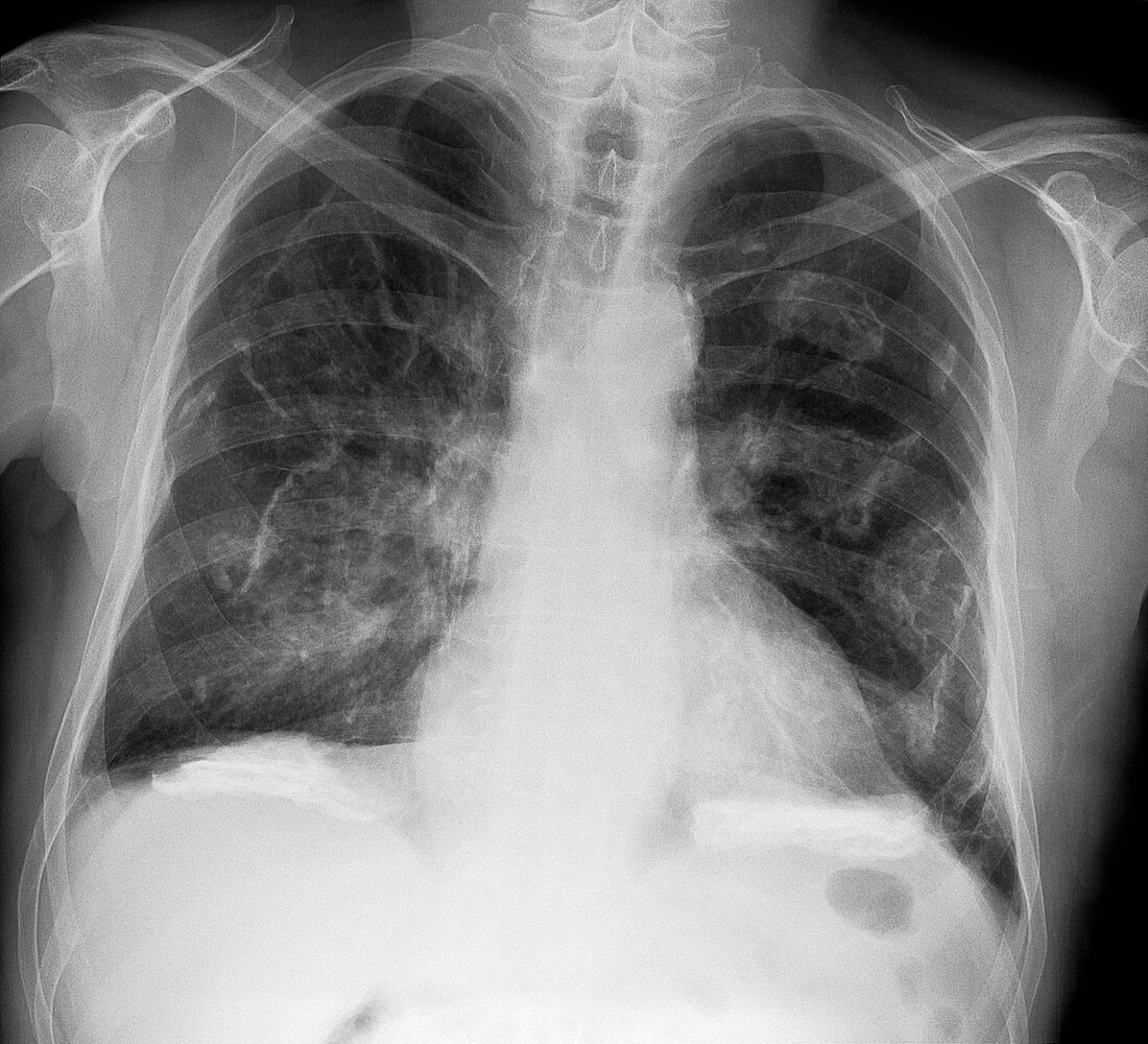 Pleural thickening due to asbestos, X-ray