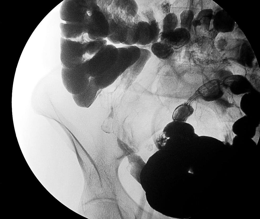 Crohn's disease, X-ray