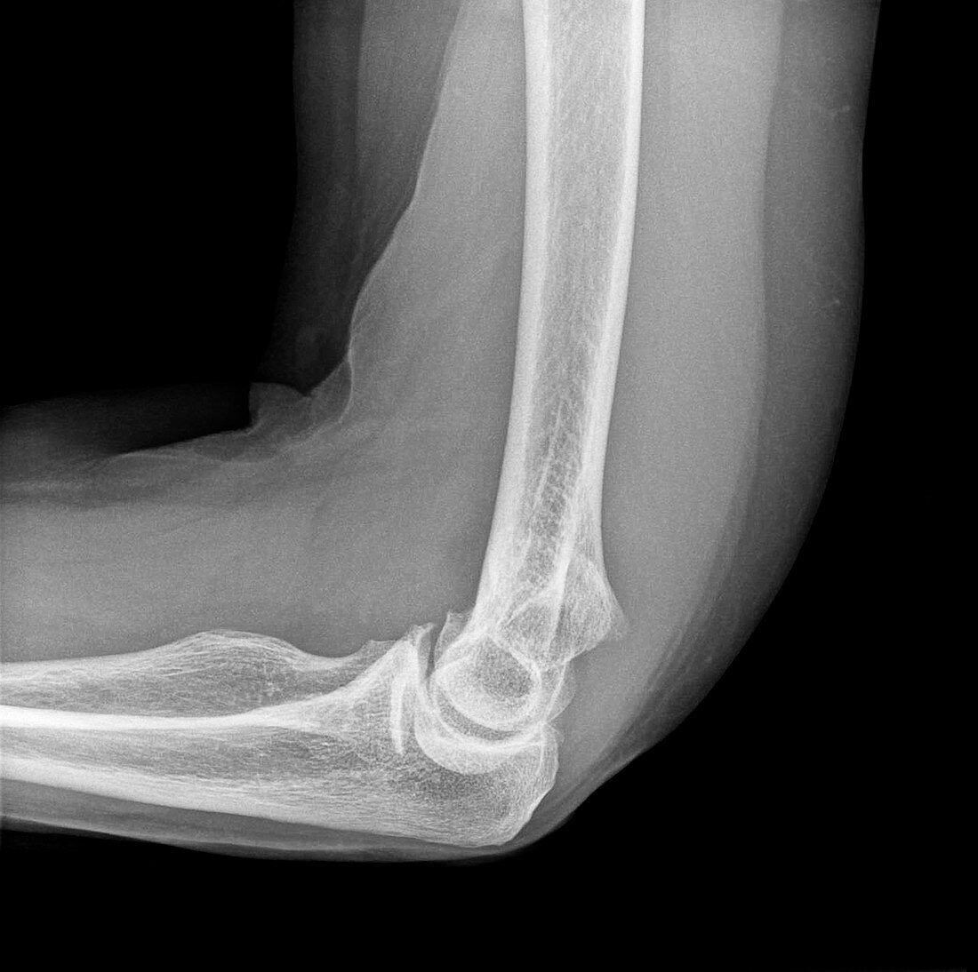 Elbow fracture, X-ray