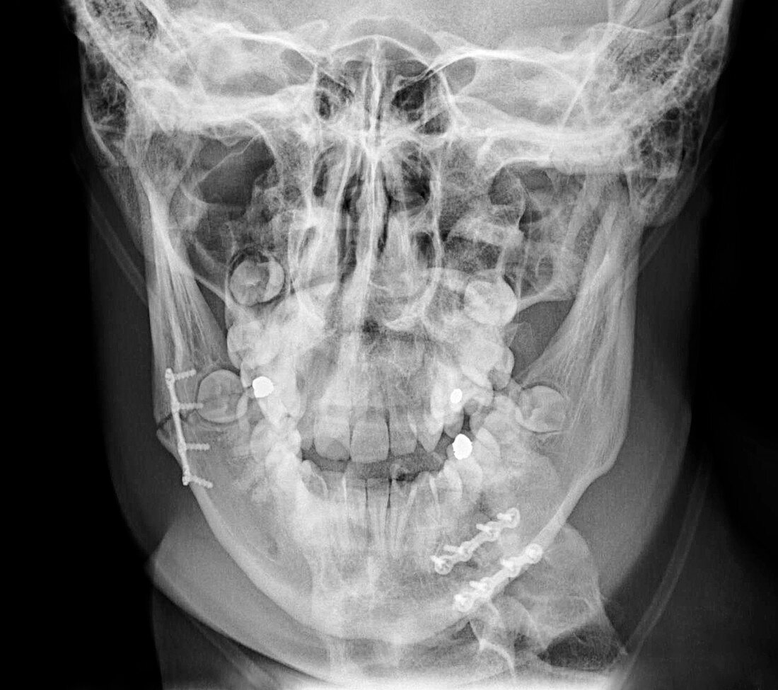 Jaw bone fracture repair, post-operative X-ray