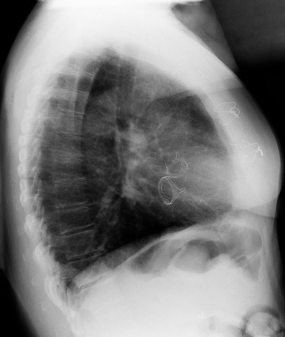 Mitral valve replacement, post-operative X-ray