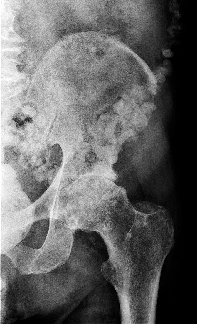 Myeloma bone scan, X-ray
