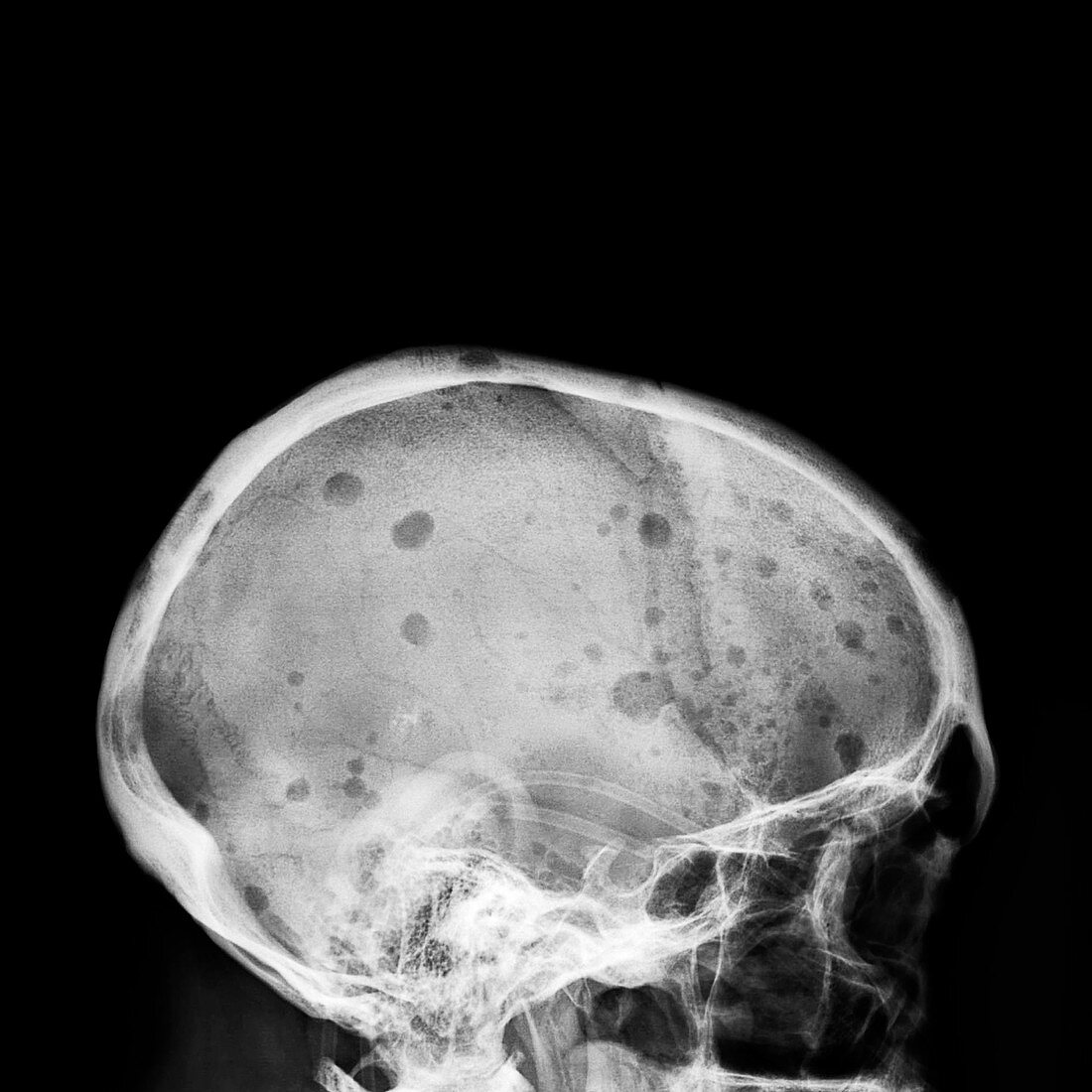 Myeloma bone scan, X-ray